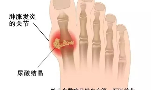 痛风与运动的关系-痛风与营养学的关系网 - 为你提供痛风病人营养不良吃什么能补、痛风与营养保健